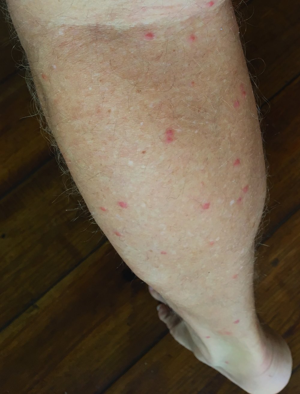  Before - that's about 20 bites on half of one leg in the first three days 